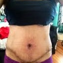 About 3 weeks post op.