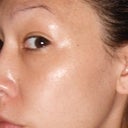 6 days later. my Forehead still has coffee ground and healing from some more intense treatment to go;- I'd guess about another week. Otherwise, so far, so good.