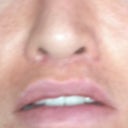 Much more upper lip show, perfect amount of distance between upper lip and columella. I had a pimple when this pic was taken so be kind, I know it's kind of ugly. I have no makeup on. I also picked at the scar on one side, that is why that side is red, and the other side is a little red. It's perfectly flat though so it's very easy to cover with makeup. I have no stiffness at all, and it feels really good.