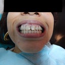 Before And After Composite Veneers