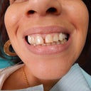 Before And After Composite Veneers