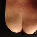 A rash and breakout from IPL