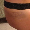 2 days post op...bruising