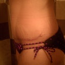 10wks post op.....trying on my new swimsuit bottoms ( even though i need a tan)