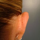 Right ear before