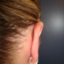 Right ear after (3 weeks later)