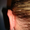 Left ear after (3 weeks later)