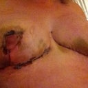 Massive brusing 2 days post op. not pretty