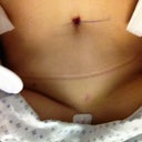 5 hours post-op... It's upside down