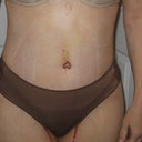 One week post-op (drains are still visible coming out of underwear)