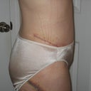 Two weeks PO (bruising is almost gone and swelling is less, but swell hell has arrived and varies throughout the day).