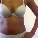 Day 16 Post-Op