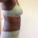 Day 16 Post-Op