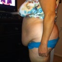 This was the amount of loose uneccesary skin 9 pounds they cut away.. yipeeeeee