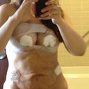 Post op day 2