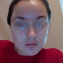 Considerable improvement over initial breakout. The acne on my forehead is left over from the breakout I took a pic of 4 or 5 days ago. There has been no new acne, so hopefully when all of this clears my skin will be pretty good. So relieved it's getting better, praying it doesn't take another turn for the worse!