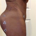 Day 3 post op