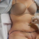 Removing bb gauze... Day 8