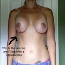 BEFORE Revision for Capsular Contracture