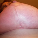 5weeks underside of left breast