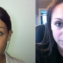 Before vs. 45 days post op
