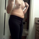 post-op day 1 : side view
