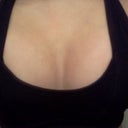 post-op day 2 : with a sports bra