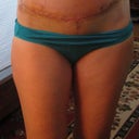 2012 - 11 & 1/2 months post tt & 1 week post scar revision - bruised & swollen - thin even scar line!