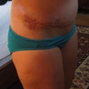 2012 - 11 & 1/2 months post tt & 1 week post scar revision - bruised & swollen - thin even scar line!