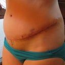 2012 - 11 & 1/2 months post tt & 1 week post scar revision - My bad side - where the dog ear was & the scar was higher, as you can see I am very swollen!