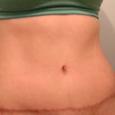 Eleven weeks post op, pre-workout (flat morning belly)