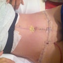 day one post op laying down.
