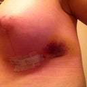 Bruising post-op day 5