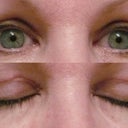 April 19th, 1 month after surgery.