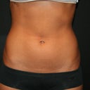My after photo about 3.5 weeks after treatment