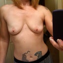 Pre-first breast aug JAN 11