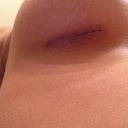 Incision right 3 weeks