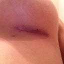 Incision left 3 weeks