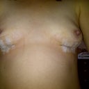 Front view 8 days - dressing removed