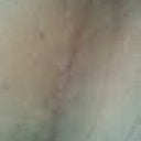 Scar 6 wks 2 days