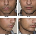 chin and jaw augmentation