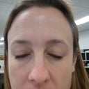 After.  I'm very pleased.  I didn't expect them to "disappear" since they are so deep from the years but they are MUCH better.
