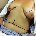 Pre-op markings... can't wait to get another picture after the bandages are off!