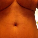 Week 4 incision scars