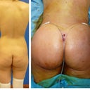 Right after surgery