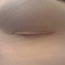 R incision. L is same but a slightly larger and more uneven.