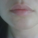 Before Juvederm
