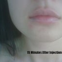 15 mins after Juvederm