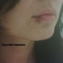 2 Days After Juvederm (at its peak of ugly bruising)