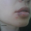 Day 1 after Juvederm